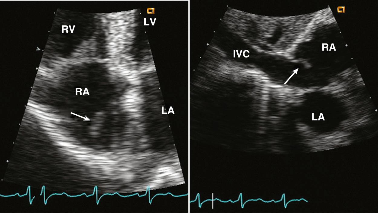 Fig. 15.3, Eustachian valve.