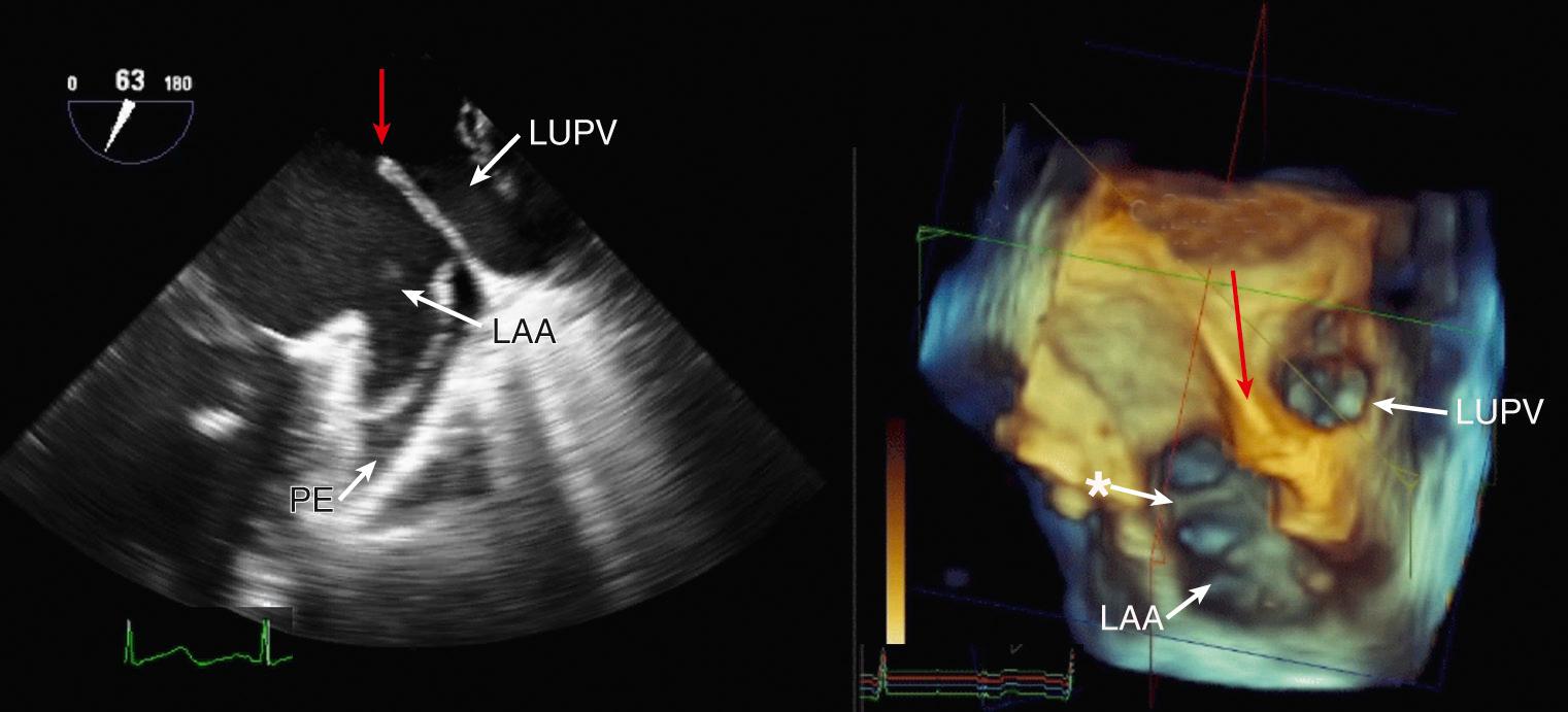 Fig. 15.4, Normal LA appendage anatomy.