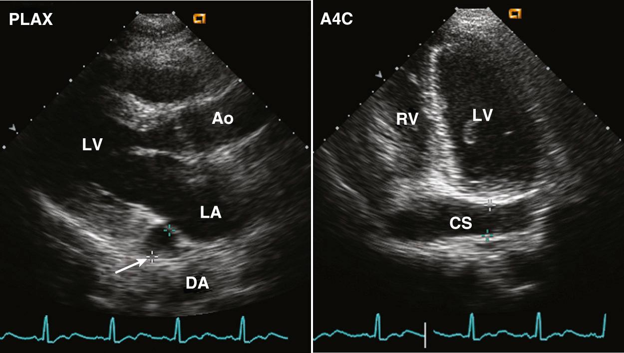 Fig. 15.5, Persistent left superior vena cava.