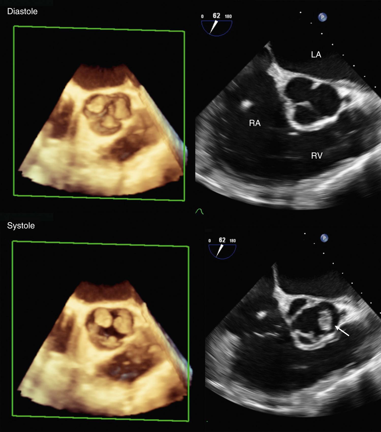 Fig. 15.6, 2D and 3D images of aortic valve vegetations.