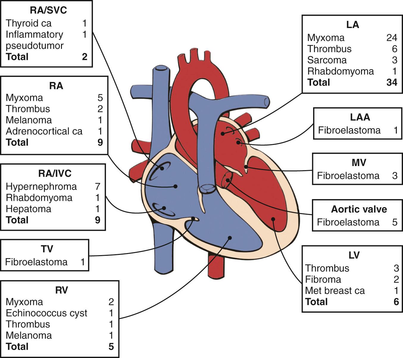 Fig. 15.7, Distribution and pathologic characteristics of cardiac masses according to intracardiac attachment site.