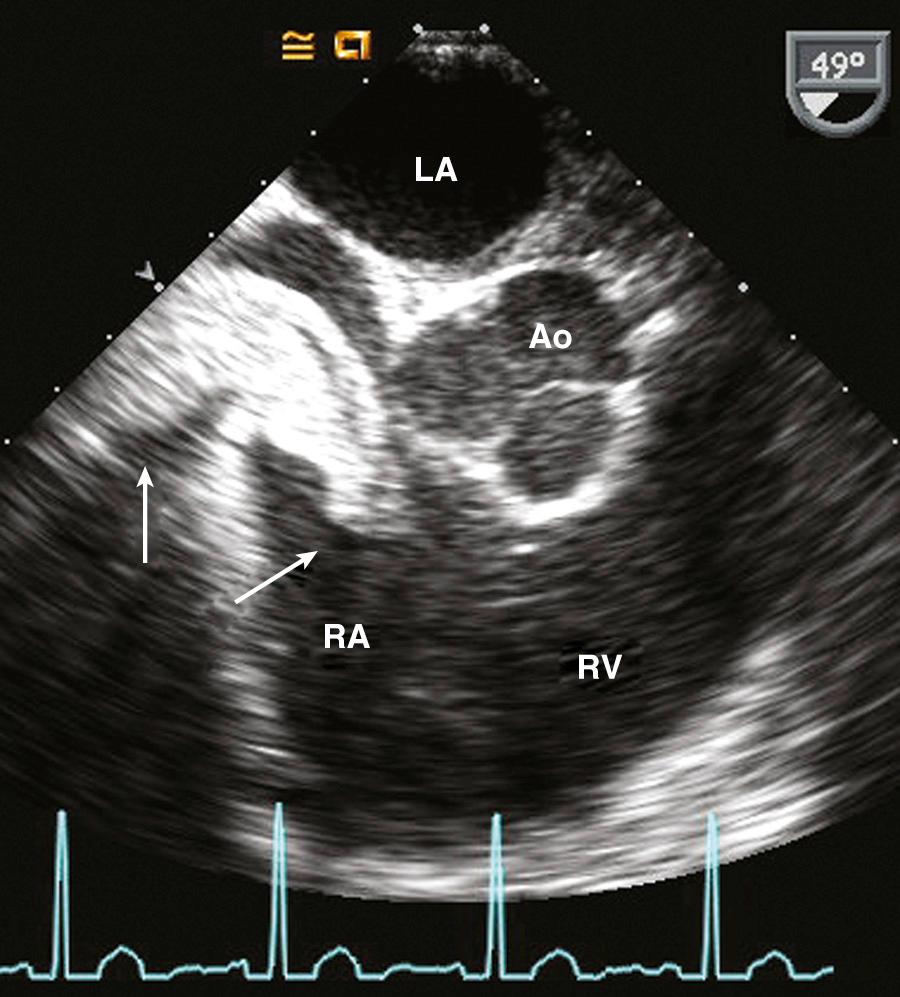 Fig. 15.9, Renal cell carcinoma.