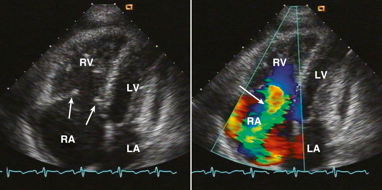 Fig. 15.10, Carcinoid heart disease.