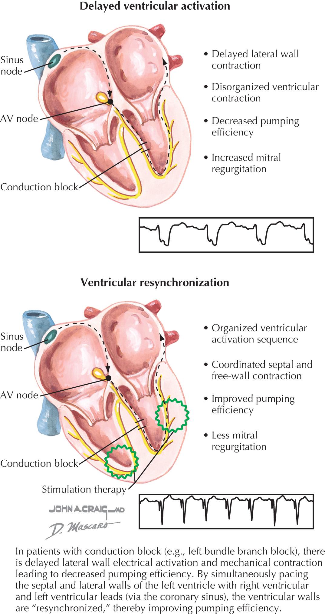 FIG 44.2, Benefit of Biventricular Pacing.