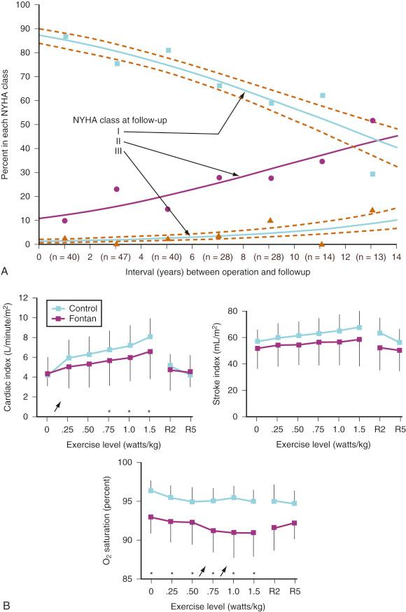 FIGURE 18.10, A, Symptomatic outcomes of 334 survivors of Fontan operations who were monitored for 1 month to 20 years. The graph illustrates the changes since surgery in patients assessed as New York Heart Association (NYHA) classification I (blue squares), II (purple circles), or III (brown triangles). Although most children exhibited good functional status (NYHA class I) immediately after surgery, mild functional limitations evolved over time. Broken lines indicate 70% confidence intervals. B, Results of exercise studies (cardiac index, stroke index, and oxygen saturation vs. exercise level) of 42 children after Fontan operation (purple squares) compared with normal control subjects (blue squares). Although the protocol was designed to achieve modest targets, significant differences emerged in the capacity of Fontan children to increase cardiac output with exercise, and systemic arterial oxygen saturation remained below normal throughout. The primary reason for the inability to increase cardiac output appears to be an inability to increase pulmonary blood flow and, consequently, systemic ventricular filling. Potential reasons for decreased arterial saturation include intrapulmonary shunting owing to arteriovenous malformations and ventilation/perfusion imbalance. Arrows indicate a significant difference ( P < .05) in values between consecutive exercise levels.