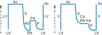 FIGURE 18.11, In the normal cardiovascular circulation (left), the pulmonary circulation (P) is connected in series with the systemic circulation (S). The right ventricle (RV) maintains a right atrial (RA) pressure that is lower than the left atrial (LA) pressure and provides enough energy for the blood to pass through the pulmonary resistance. In the Fontan circuit (right), the systemic veins are connected to the pulmonary artery (PA) without a subpulmonary ventricle or systemic atrium (the RV is not present on the right). In the absence of a fenestration, there is no admixture of systemic and pulmonary venous blood, but the systemic venous pressures are markedly increased. Ao, aorta; CV, caval veins; LV, left ventricle; V, single ventricle.