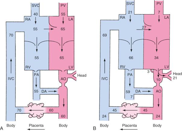 FIGURE 18.2, Fetal circulation in the late-gestation lamb. A, The numbers indicate the percentage of oxygen saturation. Oxygen saturation is greatest in the inferior vena cava (IVC), representing flow that is primarily from the placenta. The saturation of the blood in the heart is slightly greater on the left side than on the right side. B, The course of the circulation. The numbers represent the percentage of combined ventricular output. Some of the return from the IVC is diverted by the crista dividens in the right atrium (RA) through the foramen ovale into the left atrium ( LA ), where it meets the pulmonary venous return (PV), passes into the left ventricle (LV), and is pumped into the ascending aorta. Most of the ascending aortic flow goes to the coronary, subclavian, and carotid arteries, with only 10% of combined ventricular output passing through the aortic arch (indicated by the narrowed point in the aorta) into the descending aorta (AO). The remainder of the IVC flow mixes with return from the superior vena cava (SVC) and coronary veins (3%), passes into the RA and right ventricle (RV), and is pumped into the pulmonary artery (PA). Because of the increased pulmonary resistance, only 7% of the blood passes through the lungs (PV), with the rest passing through the ductus arteriosus (DA) to the AO and then to the placenta and lower half of the body.