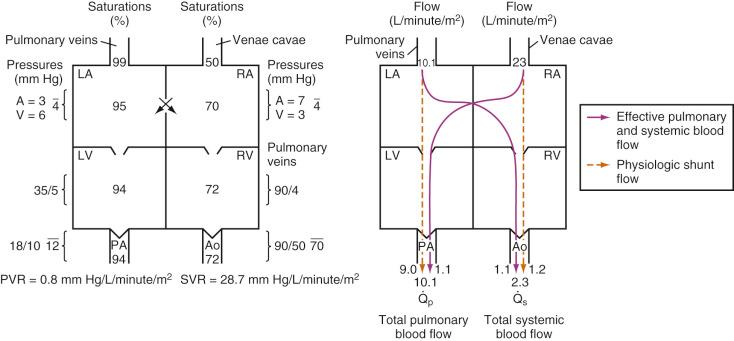 FIGURE 18.8, Saturations, pressures, and blood flows in transposition of the great arteries with a nonrestrictive atrial septal defect and a small left ventricular (LV) outflow tract gradient. Intercirculatory mixing occurs at the atrial level. Effective pulmonary and effective systemic blood flows are equal (1.1 L/minute per m 2 ) and are the result of a bidirectional anatomic shunt at the atrial level. The physiologic left-to-right shunt is 9.0 L/minute per m 2 ; this represents blood recirculated from the pulmonary veins to the pulmonary artery (PA). The physiologic right-to-left shunt is 1.2 L/minute per m 2 ; this represents blood recirculated from the systemic veins to the aorta (Ao). Total pulmonary blood flow (Q̇ P = 10.1 L/minute per m 2 ) is almost five times greater than the total systemic blood flow (Q̇ S = 2.3 L/minute per m 2 ). The bulk of pulmonary blood flow is recirculated pulmonary venous blood. In this depiction, pulmonary vascular resistance (PVR) is low (approximately 1/35 of systemic vascular resistance [ SVR ]) and there is a small (17 mm Hg peak to peak) gradient from the LV to the PA. These findings are compatible with the high pulmonary blood flow depicted. LA, left atrium; RA , right atrium; RV , right ventricle.