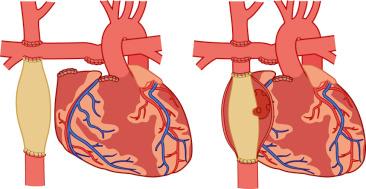 FIGURE 18.9, Fontan modifications: extracardiac conduit (left) and lateral tunnel with fenestration (right).