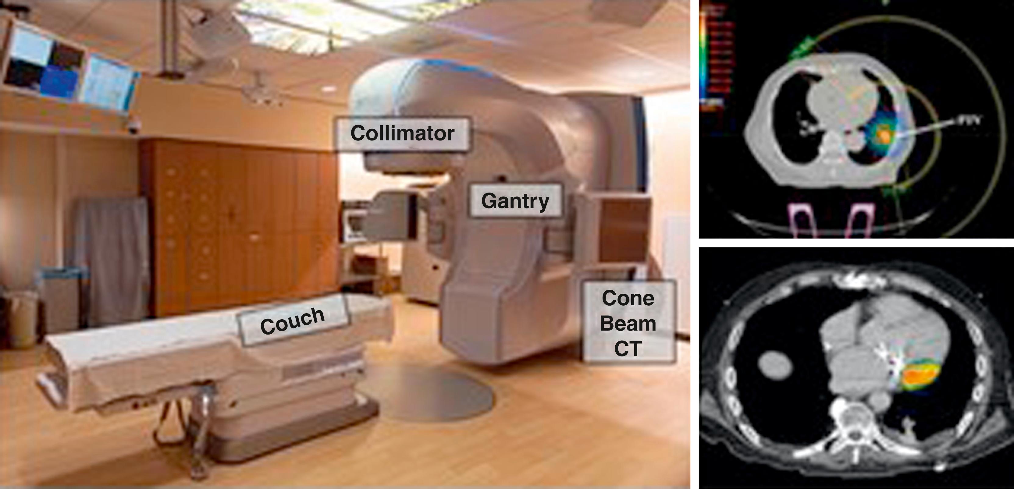 Fig. 133.1, Stereotactic ablative radiotherapy (SABR) uses a gantry to accelerate electrons to create x-rays, which are filtered and shaped in the collimator and delivered into the patient lying on the couch.