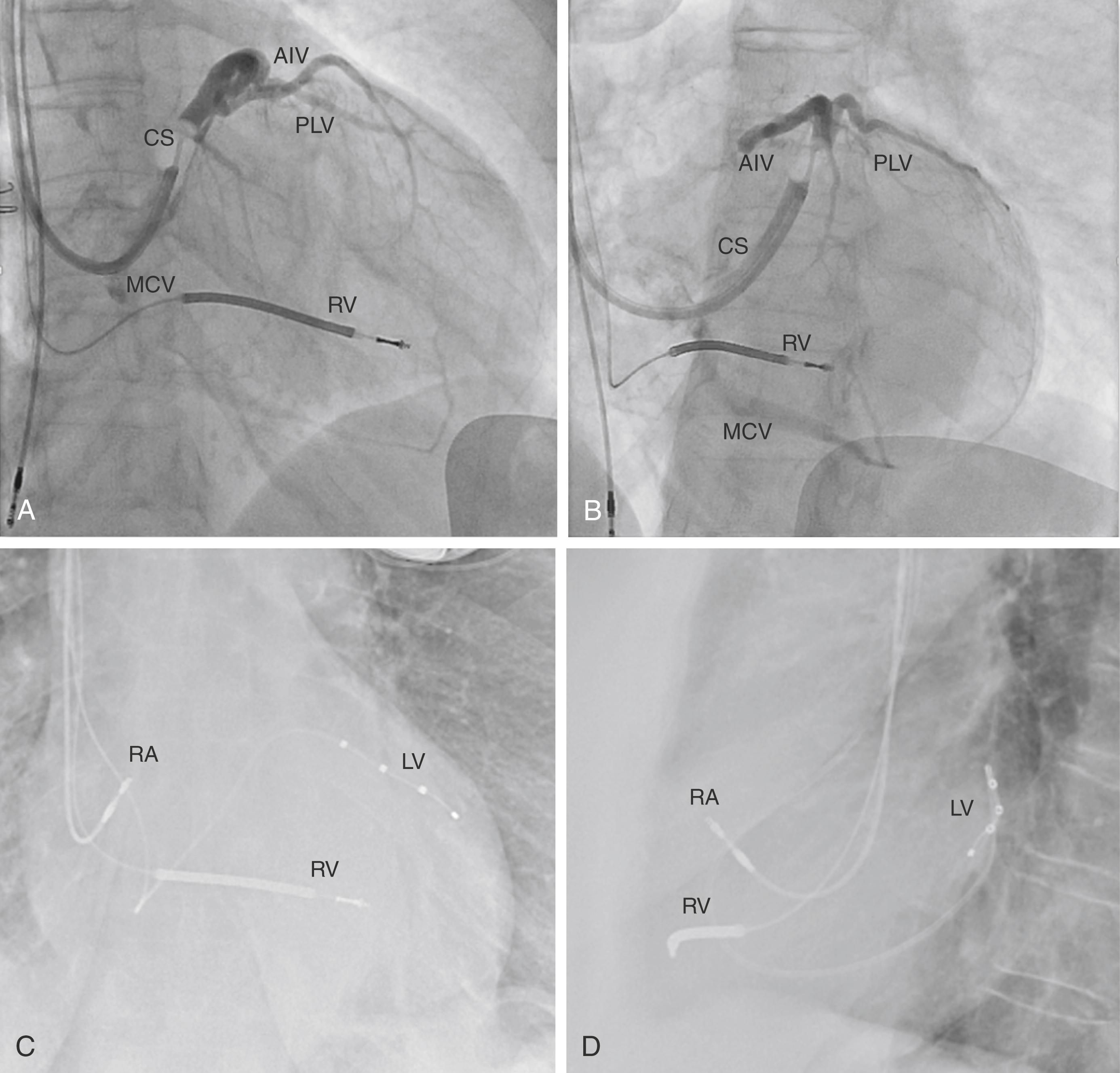 Fig. 125.1, Standard fluoroscopic venograms of coronary sinus (CS) venous system and postprocedure posteroanterior and lateral radiographs.