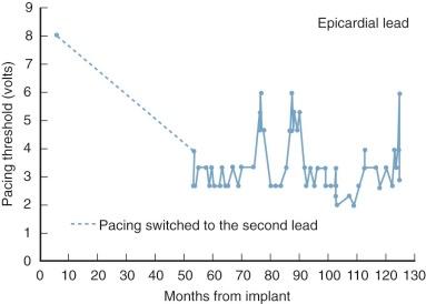 Figure 16-2, Variation in pacing threshold after development of complete heart block following repair of “single” ventricle. Note episodic and unpredictable sudden increases in threshold, which could have led to sudden death if output from the pulse generator had been insufficient to overcome them.