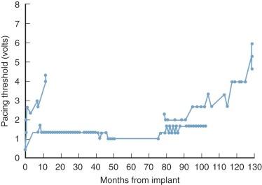 Figure 16-3, Unpredicted rapid increase in pacing threshold about 7 years after implanting pulse generator a few days after development of complete heart block during intracardiac repair. Patient had congenitally corrected transposition of the great arteries.