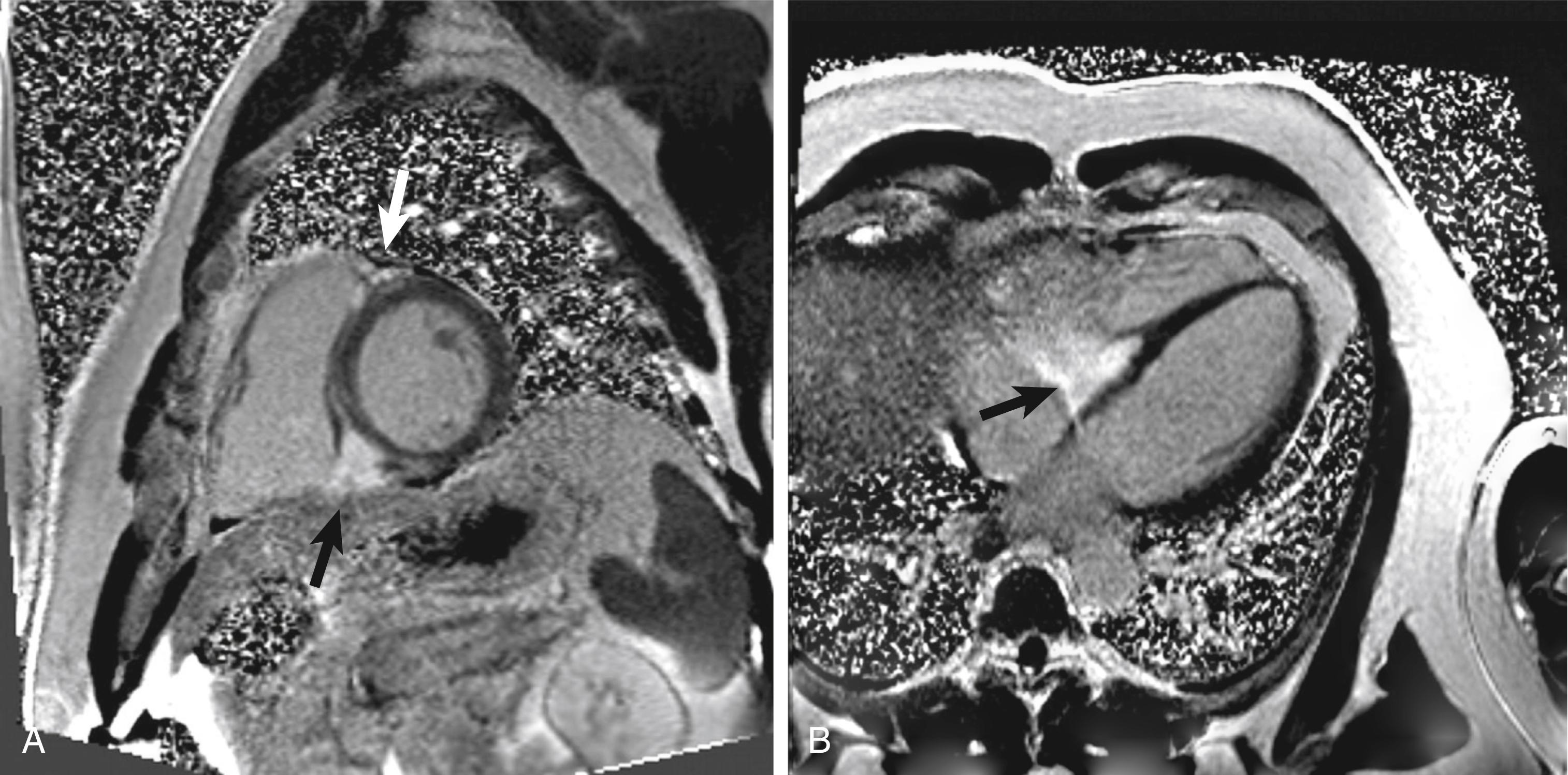 Fig. 109.1, (A) Cardiac magnetic resonance image of the short axis at the basal ventricular level demonstrates focal regions of late gadolinium enhancement along the basal inferoseptum ( black arrow ) and anteroseptum ( white arrow ). (B) Four-chamber view illustrates the extension of the late enhancement from the basal septum into the right ventricle.