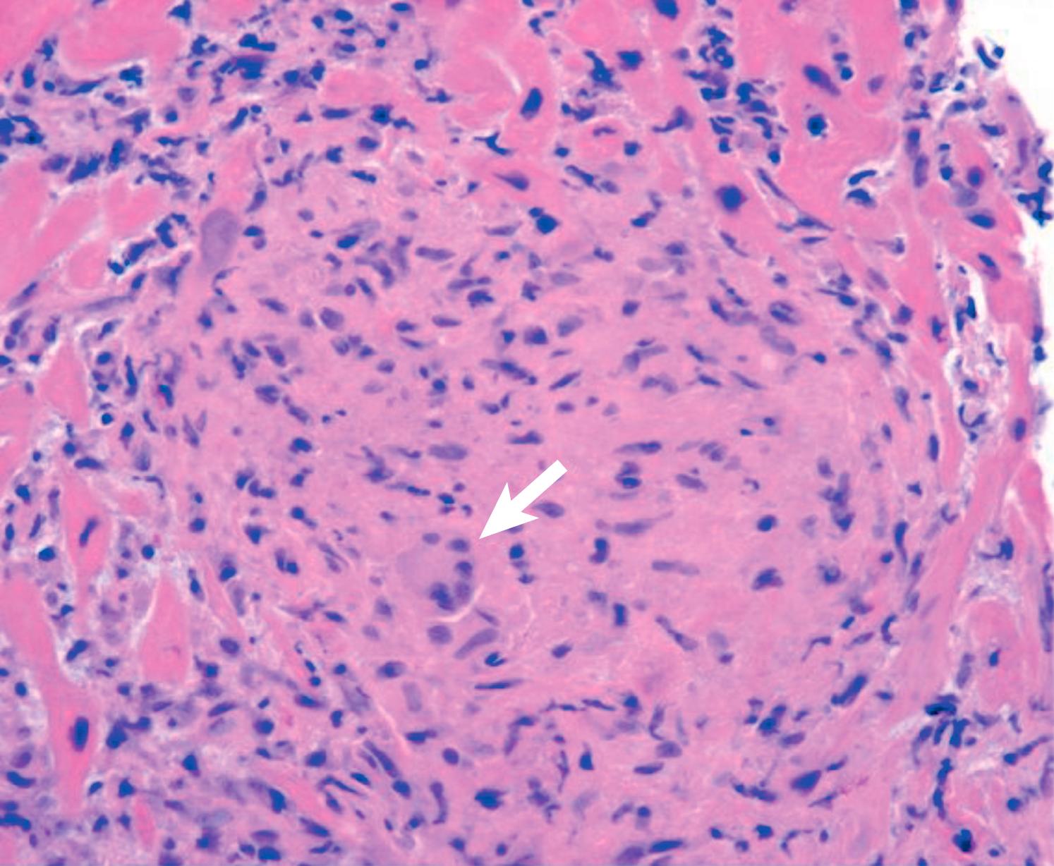 Fig. 109.2, Endomyocardial biopsy slides from the patient in Fig. 109.1. Hematoxylin and eosin stained section shows well-formed nonnecrotizing granulomas with occasional macrophage giant cells ( arrow ) and a peripheral lymphocytic infiltrate consistent with sarcoidosis.