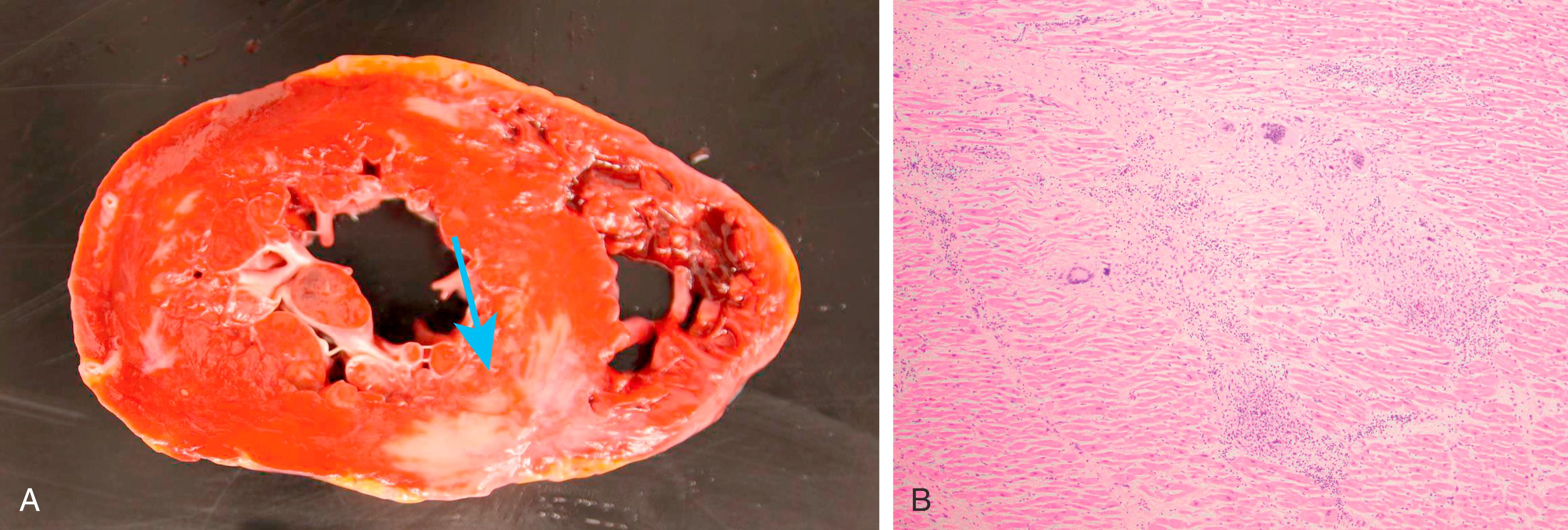 Fig. 109.3, (A) Gross pathology specimen from a patient with normal ejection fraction who died suddenly and was determined postmortem to have active cardiac sarcoidosis. The gross pathology specimen shows an area of fibrosis in a noncoronary distribution, involving the basal septum ( arrow ). (B) Hematoxylin and eosin stained section from the autopsy specimen showing active granulomatous myocarditis consistent with cardiac sarcoidosis.