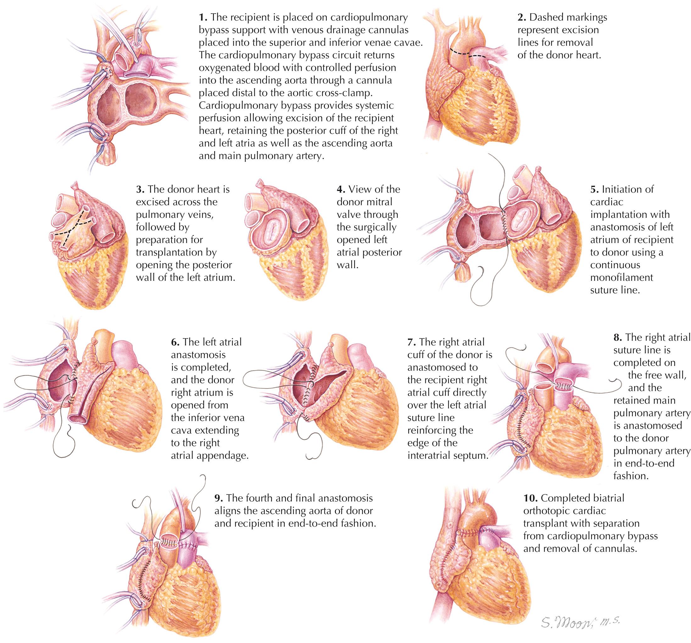 FIG 34.1, Technique of Biatrial Cardiac Transplantation.