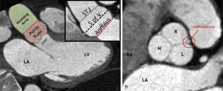 Figure 37.1, Aortic root complex. (A) Three-chamber view of the left ventricle (LV) on CT shows the aortic root complex, consisting of the annulus, aortic valve leaflets, aortic valve leaflet attachments, sinuses of Valsalva (S of V), aortic valve interleaflet trigones, and sinotubular junction (STJ). (B) Short-axis view of the aortic root at the level of the sinuses of Valsalva on CT shows the leaflets and commissures of the aortic valve. L, Left coronary leaflet or cusp; LA, left atrium; LVOT, left ventricular outflow tract; N, noncoronary leaflet or cusp; R, right coronary leaflet or cusp; RA, right atrium; RV, right ventricle.