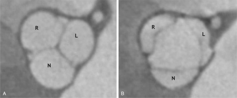 Figure 37.2, Aortic valve during ventricular end-diastole and ventricular end-systole. (A) Short-axis view of the aortic root at the level of the sinuses of Valsalva on CT shows closure or coaptation of the aortic valve leaflets or cusps during ventricular end-diastole. (B) Short-axis view of the aortic root at the level of the sinuses of Valsalva on CT shows opening of the aortic valve leaflets or cusps during ventricular end-systole. L, Left coronary leaflet or cusp; N, noncoronary leaflet or cusp; R, right coronary leaflet or cusp.