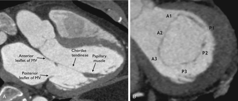 Figure 37.3, Mitral valve (MV) complex. (A) Three-chamber view of the left ventricle on CT shows the mitral valve complex consisting of the mitral annulus, mitral valve leaflets, chordae tendineae, and papillary muscles. (B) Short-axis view of the mitral valve complex at the level of the mitral annulus on CT shows segmental anatomy of the mitral valve leaflets. A1, Anterior segment of the anterior leaflet of mitral valve; A2, middle segment of see the anterior leaflet of the mitral valve; A3, posterior segment of the anterior leaflet of the mitral valve; P1, anterior scallop of the posterior leaflet of the mitral valve; P2, middle scallop of the posterior leaflet of the mitral valve; P3, posterior scallop of the posterior leaflet of the mitral valve.