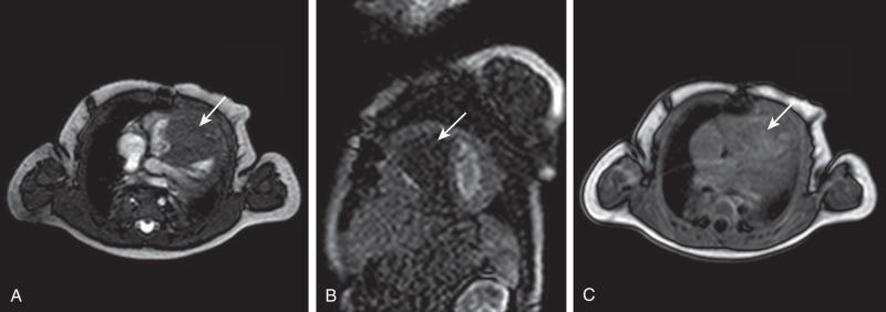 Figure 80.3, Rhabdomyoma in an infant with neurostigmata of tuberous sclerosis.