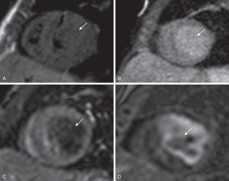 Figure 80.4, Cardiac fibroma in a 1-year-old boy with ventricular tachycardia.