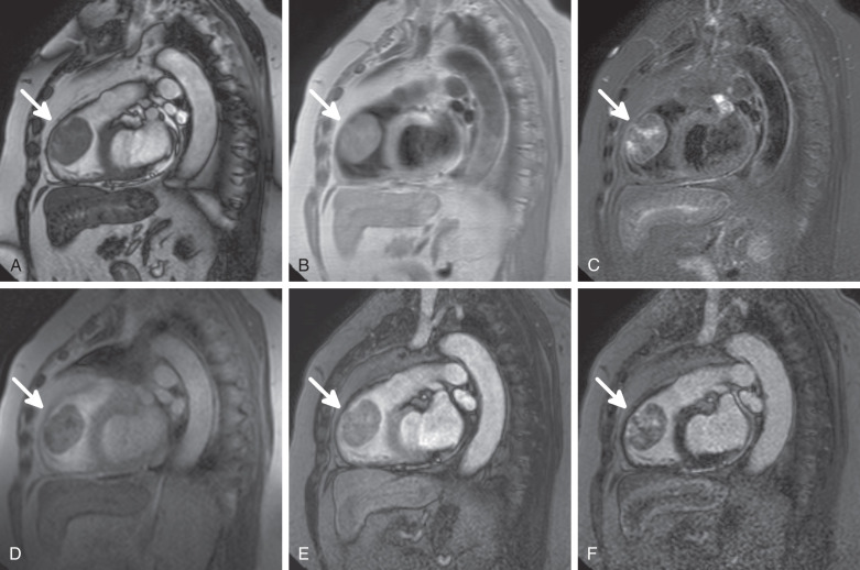 Figure 32.2, Myxoma (arrows) of the right ventricular outflow tract. (A) Steady-state free precession image of the right ventricle. The slightly nonhomogeneous T2-/T1-weighted signal is mostly similar to the myocardium. (B) Black blood, T1-weighted turbo spin-echo (TSE) image in the same view; nonhomogeneous, intermediate signal intensity. (C) T2-weighted TSE image. Nonhomogeneous signal characteristics show areas of increased and decreased signal intensity. Myxomatous components and some blood degradation products can cause a signal increase, whereas calcification and hemosiderin (or, to a lesser extent) fibrotic components result in decreased signal. (D) First-pass perfusion image showing nonhomogeneous contrast uptake during administration of extracellular IV contrast material (Gd-DO3A-butrol). (E) Early enhancement inversion recovery turbo field-echo image taken 2 to 7 minutes after contrast administration using intentionally long inversion times, demonstrating mildly nonhomogeneous contrast enhancement. (F) Delayed enhancement inversion recovery turbo field-echo image taken 10 to 20 minutes after contrast administration using inversion times to null the myocardium. The mass shows nonhomogeneous contrast enhancement as a sign of a heterogenous histologic structure.