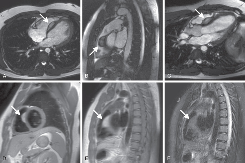 Figure 32.3, Lipoma (arrows) of the interventricular septum. (A) Steady-state free precession (SSFP) axial image demonstrates a lesion with a dark rim in the interventricular septum projecting into the right ventricle. (B) SSFP right ventricular outflow tract image of the lesion. (C) SSFP three-chamber view of the same lesion. (D) T1-weighted fast spin-echo (FSE), black blood, short-axis image. The lesion matches subcutaneous fat in its signal characteristics. (E) T1-weighted FSE right ventricular outflow tract image demonstrates the lesion in another plane. (F) Signal dropout of the lesion on the fat-suppressed, T2-weighted, triple inversion recovery FSE image.