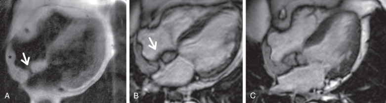 Figure 32.4, Lipomatous hypertrophy of the interatrial septum. (A) Axial double-inversion recovery image, high signal in the interatrial septum, in a dumbbell shape, with sparing of the interatrial septum (arrow). Note the signal in the interatrial septum matches that of the epicardial fat. In this case, fatty infiltration is also seen along the posterior wall of the right atrium, continuing into the crista terminalis. Still diastolic images from axial (B) and four-chamber (C) steady-state free precession sequences demonstrate etching artifact due to a fat-fluid interface in the interatrial septum, with sparing of the fossa ovalis ( arrow, B) through the process.