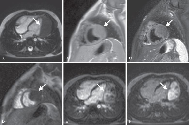 Figure 32.5, Fibroma (arrows) of the left ventricle in a 4-year-old boy causing ventricular arrhythmias. The patient underwent implantable cardioverter-defibrillator placement. (A) Steady-state free precession four-chamber image demonstrates an isoattenuating mass in the lateral wall of the left ventricle. (B) Short-axis (SA) T1-weighted, blood-suppressed turbo spin-echo image. The mass shows intermediate signal intensity. (C) SA fat-saturated T2-weighted image. The fibroma is slightly darker compared to the myocardium. (D) SA first-pass perfusion image during extracellular contrast material application. The tumor does not take up contrast. (E) Four-chamber early postcontrast image taken 2 to 3 minutes after gadolinium administration, nulled to the myocardium. The mass shows heterogenous contrast enhancement. (F) Four-chamber inversion recovery delayed hyperenhancement image taken 20 minutes after contrast material injection. The tumor demonstrates marked late enhancement. The borders are well defined.