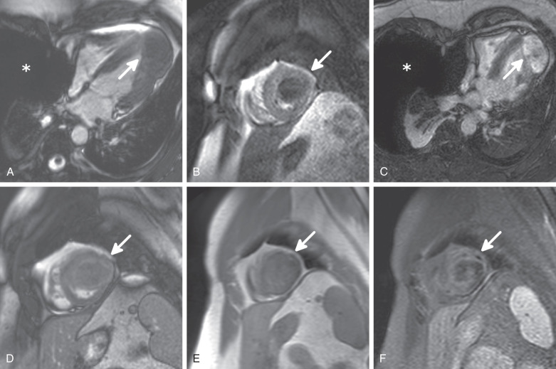 Figure 32.6, Left ventricular fibroma (arrows). An unsuspected finding is spontaneous pneumothorax (PTX). (A) Four-chamber (4CH) balanced steady-state free precession (b-SSFP) frame. The tumor is isointense compared to the myocardium ( asterisk, PTX). (B) Short-axis first-pass perfusion image. The mass shows low vascularization during extracellular gadolinium contrast material administration. (C) 4CH delayed enhancement (inversion recovery turbo field-echo) image. The fibroma demonstrates marked enhancement 10 minutes after injection ( asterisk, PTX). The collapsed right lung can be seen ventrolateral to the spinal column, behind the asterisk. (D) Short-axis b-SSFP frame after contrast administration demonstrates peripheral enhancement. (E) Short-axis, T1-weighted, blood-suppressed turbo spin-echo image. The mass has slightly heterogenous signal intensity. (F) Short-axis, T2-weighted, blood-suppressed spectral inversion recovery image. The fibroma has a central nonhomogeneous decreased signal.