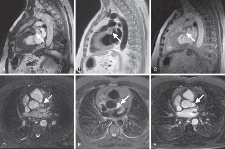 Figure 32.7, Hemangioma. Coronary CT angiography performed for chest complaints revealed no coronary lesions, but showed a mass located under the left main coronary artery bifurcation, adjacent to the aortic root (arrows). This is a relatively common location of a paracardiac hemangioma. Cardiac MRI was performed for further characterization. (A) Sagittal balanced steady-state free precession end-diastolic frame. This well-circumscribed abnormality has a higher T2-/T1-weighted signal compared to the myocardium. (B) Sagittal T1-weighted black blood turbo spin-echo (TSE) image. The tumor shows intermediate signal, similar to the myocardium. (C) Sagittal first-pass image. Marked first-pass contrast uptake suggests a highly vascularized tumor. (D) Axial reconstruction of an isotropic three-dimensional, high-resolution, navigator-driven, T2-prepped, fat-suppressed, balanced fast field echo sequence. No signs of involvement of the adjacent structures. (E) Axial T2-weighted black blood TSE image. The tumor shows increased signal intensity compared to the myocardium. (F) Axial delayed enhancement image after gadolinium contrast administration. The enhancement resembles that of the blood pool.