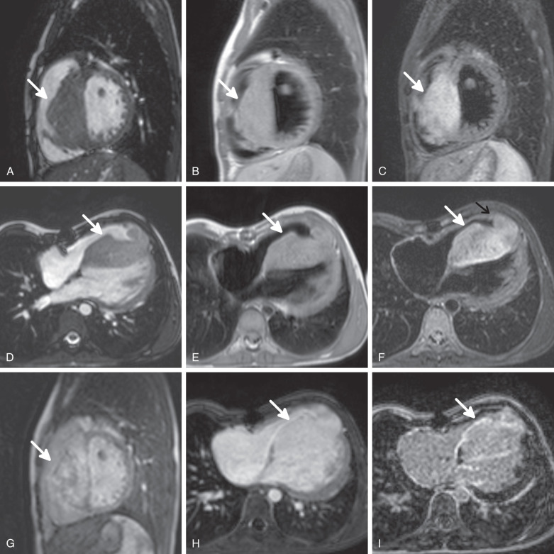 Figure 32.8, Hemangioma. The patient's hemangioma was discovered in early childhood while open heart surgery was performed to close her atrial septal defect. After several years of follow-up, the patient developed ventricular arrhythmias. Cardiac MRI was requested for further workup of the hemangioma (white arrows). (A) Sagittal balanced steady-state free precession (b-SSFP) end-diastolic frame. The thickened interventricular septum and right ventricular trabeculae can be visualized. T2-/T1-weighted signal intensity is approximately equal to the myocardium. (B) Sagittal T1-weighted black blood turbo spin-echo (TSE) image. The tumor shows intermediate signal, similar to the myocardium. (C) Sagittal T2-weighted black blood TSE image. The hemangioma spans the interventricular septum and spreads into several right ventricular trabeculae. (D) Axial b-SSFP end-diastolic frame after contrast administration. The tumor developed higher T2-/T1-weighted signal intensity compared to the myocardium. (E) Axial T1-weighted black blood TSE image. The tumor shows an intermediate signal, similar to the myocardium. (F) Axial T2-weighted black blood TSE image. The hemangioma spans all along the interventricular septum and spreads into several right ventricular trabeculae and a portion of the right ventricular apex (black arrow). (G) Sagittal early enhancement magnitude image after extracellular gadolinium contrast administration. The contrast uptake is nonhomogeneous, but roughly similar to the blood pool. (H) Axial early enhancement image. The enhancement resembles the blood pool. (I) Axial delayed enhancement image. The outer rim of the tumor shows hyperenhancement, whereas the vast majority of the lesion is homogeneous with that of the blood pool.