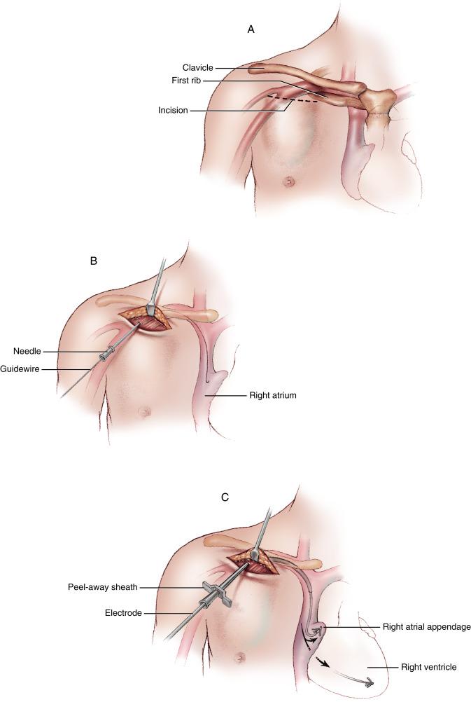 Figure 44-1, A An incision is made on the anterior chest wall below the clavicle. An incision placed on either the right or left side of the chest can be used with equal ease; the choice is based on surgeon preference or patient handedness. Local anesthesia is used. A pocket is formed by separating the subcutaneous tissues from the fascia of the pectoralis major muscle. Hemostasis in the pocket must be meticulous. In children and in some adults with insufficient subcutaneous tissues, the pocket for the pulse generator can be formed beneath the pectoralis major muscle to protect the pulse generator from trauma. General anesthesia is required in these cases. B The superior edge of the incision is retracted to provide access to the first rib–clavicle passageway, beneath which lies the subclavian vein. A needle with a syringe attached is used to locate and penetrate the vein. A flexible J-tip guidewire is passed through the needle into the superior vena cava. The position of the guidewire is confirmed by fluoroscopy. C The needle is withdrawn and replaced with a peel-away catheter sheath. The pacing electrode is passed with ease through the sheath into the superior vena cava. The sheath is then peeled away from the electrode catheter. The electrode is manipulated under fluoroscopic guidance into the right atrial appendage or the apex of the right ventricle, depending on the desired location of cardiac stimulation. When two electrodes are required for atrioventricular sequential pacing, it is usually easier to make separate entry into the subclavian vein rather than attempting to simultaneously place two electrodes through a single catheter sheath. Based on individual patient conditions, a number of tricks for shaping and manipulating the electrode catheter guidewires may be required to reach the desired point in the right heart. A gentle curve anteriorly usually guides the electrode into the right ventricle and out the pulmonary artery. Withdrawal of the electrode allows it to drop into the apex of the right ventricle, where it can be firmly seated with a straight guidewire. A full J-shaped curve of the guidewire allows the electrode to be pulled back into the right atrial appendage. The tines near the tip of the electrode catch in right heart trabeculations to hold its position; generally, however, more secure fixation is desired and is accomplished using a screw-in electrode.