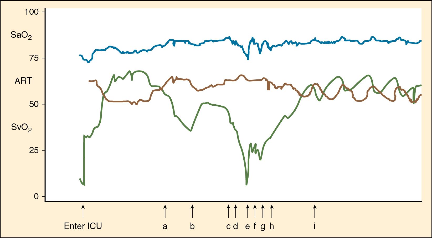 Fig. 59.2, Blood Pressure Conserved as Circulation Fails.