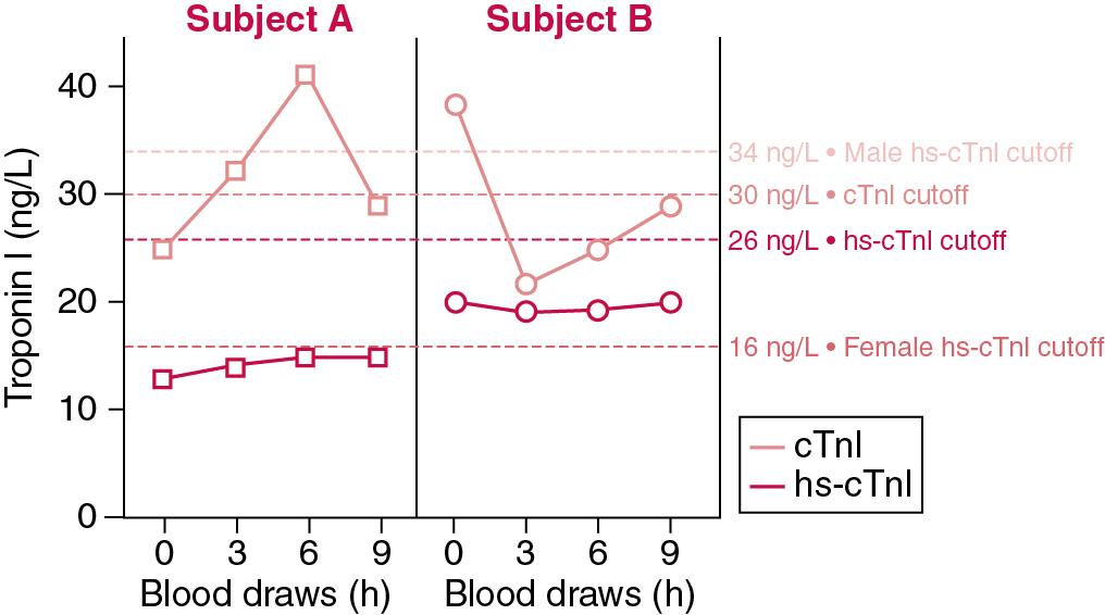 FIGURE 48.16, Representative serial cardiac troponin I (cTnI) concentrations in two patients measured by a contemporary and a high-sensitivity cTnI (hs-cTnI) (with sex-specific cutoffs) assay demonstrating analytical “noise” of the contemporary assay.
