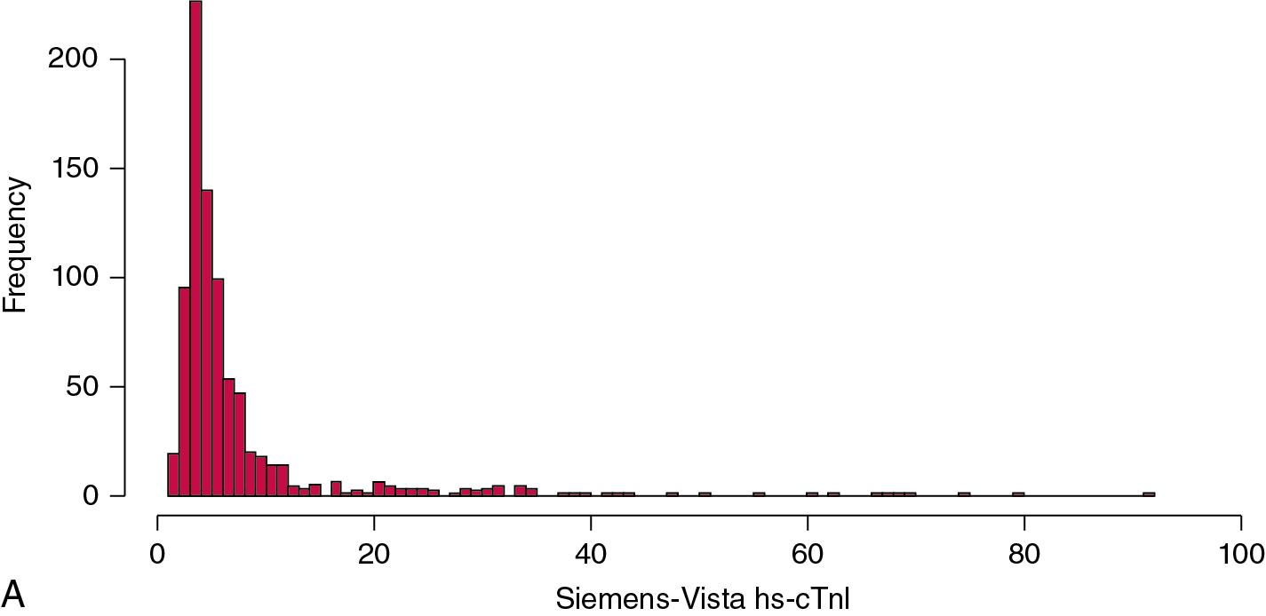 FIGURE 48.10, Representative histograms for (A) hs-cTnI and (B) hs-cTnT assays of plasma specimens from apparently healthy individuals. cTnI, Cardiac troponin I ; cTnI, cardiac troponin T.