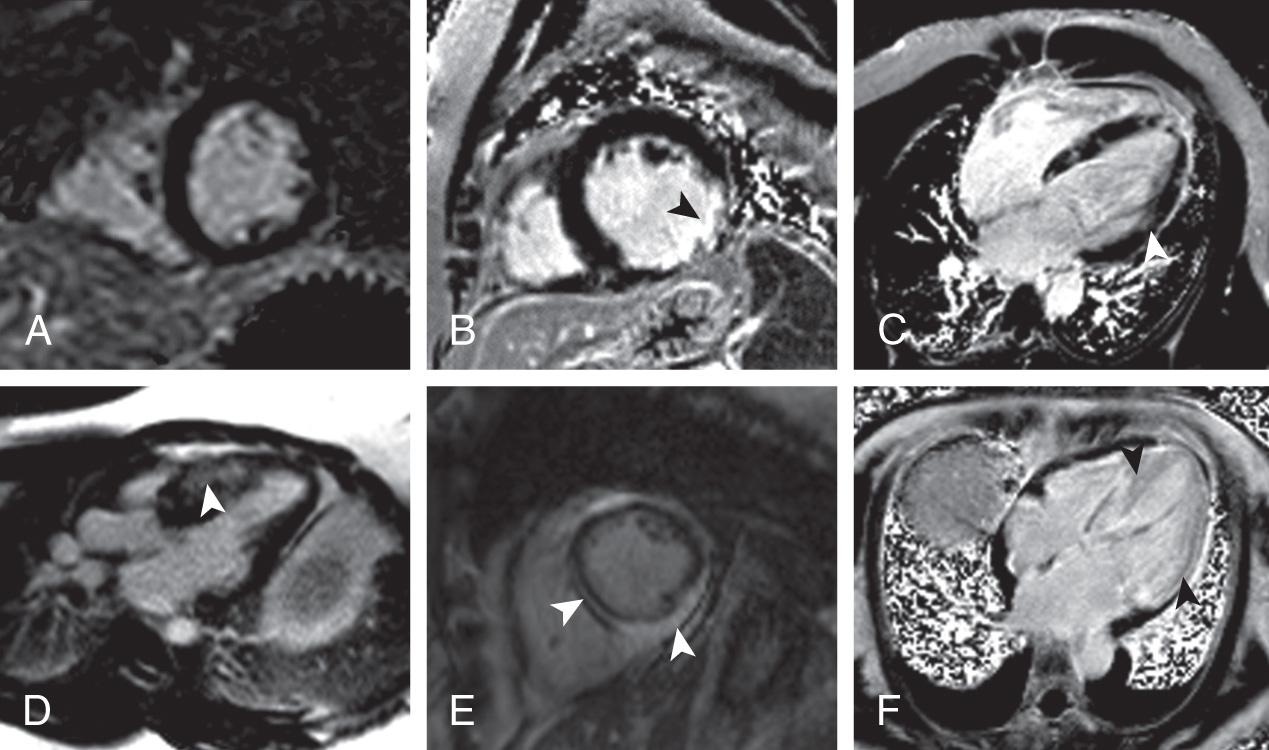 Fig. 10.3, Late gadolinium enhancement (LGE) patterns. A, Normal short-axis late gadolinium enhancement image. B, Transmural scar in the circumflex territory. C, Cardiomyopathy secondary to sarcoidosis. D, Hypertrophic obstructive cardiomyopathy with basal anteriorseptal mid-myocardial LGE. E, Myocarditis with both midmyocardial and epicardial LGE. F, Cardiac amyloidosis with diffuse enhancement of the entire left ventricle. The arrowheads point to the areas of myocardial LGE.