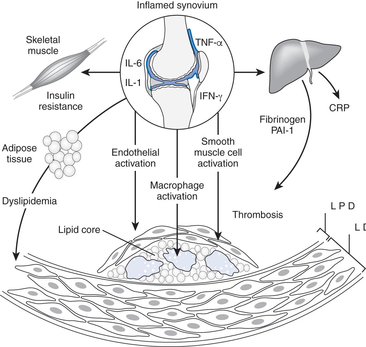 Fig. 47.1, Proposed mechanisms of accelerated atherosclerosis in patients with rheumatoid arthritis. CRP, C-reactive protein; IFN, interferon; IL, interleukin; PAI, plasminogen activator inhibitor; TNF, tumor necrosis factor.