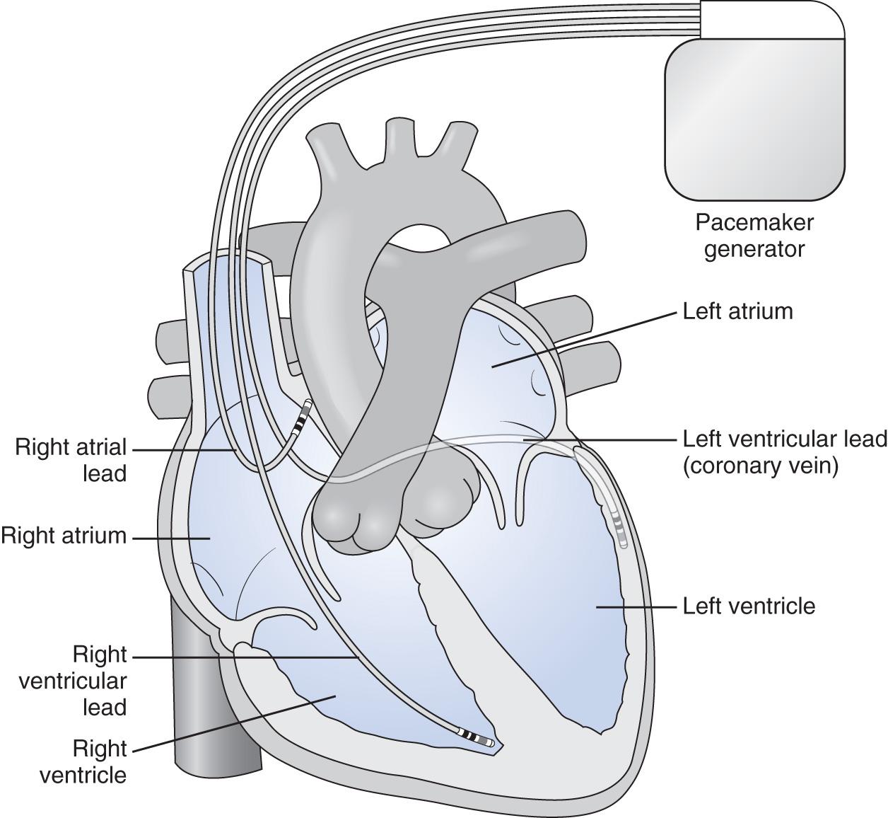 Fig. 38.3, Example of the components of a biventricular pacing system, with pacemaker generator a right atrial lead, a right ventricular lead, and a left ventricular lead.