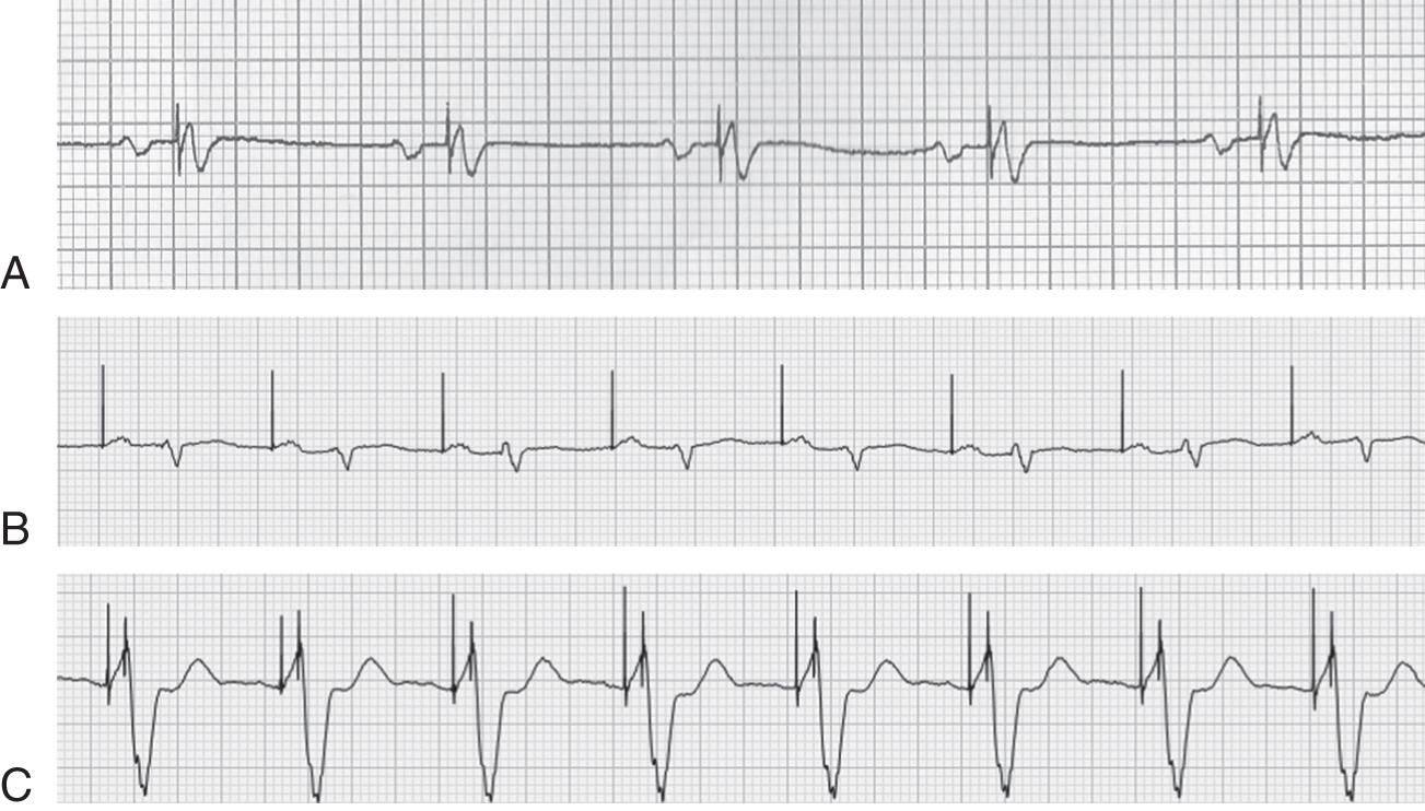 Fig. 38.4, Example of standard right ventricular pacing (A) , atrial pacing (B) , and biventricular pacing (C) . Note with biventricular pacing two distinct pacer spikes are visible (though this is not always so easily visualized).