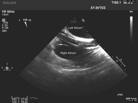 Fig. 62.1, Venous drainage cannula in the superior vena cava.