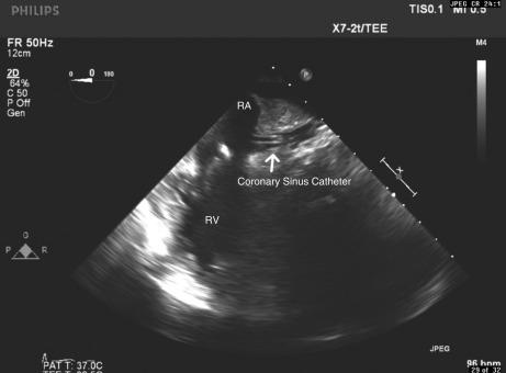 Fig. 62.2, Coronary sinus catheter for delivery of retrograde cardioplegia. RA , Right atrium; RV , right ventricle.