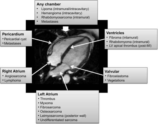 Figure 17.1, The Typical Location of Common Cardiac Masses. The typical locations of the most common masses are illustrated. Please note, however, that the location of the various pathologies can vary and many cardiac tumours can occur in any chamber.