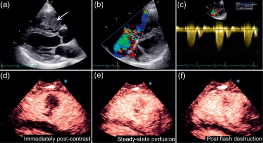 Figure 17.2, Right Ventricular Mass assessed with Echocardiography. A 40-year-old female presented with signs of right-sided heart failure. Transthoracic echocardiography showed a large, mobile, irregular mass within the RV chamber which prolapsed into the right atrium (a). The tricuspid valve was disrupted and there was severe tricuspid regurgitation seen on colour flow (b) and continuous wave Doppler (c). This case illustrates the ability of echocardiography to readily identify a cardiac mass and its functional consequences. Although tissue characterisation is generally best assessed with CMR, contrast echocardiography with power modulation imaging can also be used to assess vascularity (dependent on local expertise) (d–f): Panel D shows intravenous contrast agent (microbubbles) outlining the mass in the RV soon after administration; Panel E shows contrast uptake in the myocardium (steady-state perfusion) and in the RV mass suggesting it has high vascularity; Panel F shows that after a high-power impulse is used to destroy the contrast bubbles, there is early replenishment within the mass even before the septal myocardium, confirming significant vascularity. A large intravascular mass extending from the pelvic veins and inferior vena cava was found at surgery. Histopathology confirmed a rare case of intravascular leiomyoma.