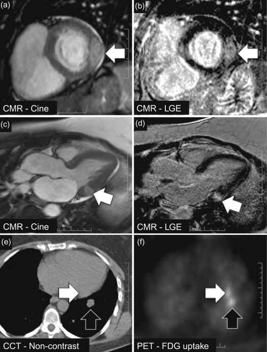 Figure 17.4, Metastatic Melanoma. A patient with previously excised malignant melanoma underwent CMR for suspected cardiac metastases. Short-axis images show an expansile hyperenhancing mass in the lateral LV wall on post-contrast cine imaging (arrow a) and LGE imaging (arrow, b). Corresponding 3-chamber post-contrast cine and LGE images also confirm the presence of a hyperenhancing lateral wall mass (arrows, c,d). The patient was scheduled for a PET-FDG/CT scan for functional assessment of the mass. The contrast axial CCT images (e) acquired as part of the PET/CT study do not clearly show a significant myocardial lesion at the expected location in the lateral LV wall (white arrow, e) – but an adjacent lung metastasis is seen (black arrow, e). Matched FDG uptake images clearly demonstrate uptake not only in the lung metastasis (black arrow, e) but also in the previously occult myocardial metastasis (white arrow, e). Note that the appearances are not specific to melanoma but could be seen in many forms of malignant secondary tumour.