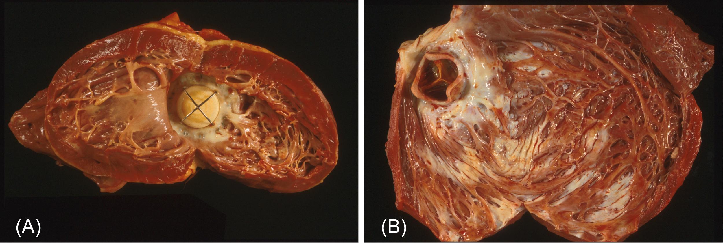 Figure 17.2, Late postoperative cardiac failure following valve replacement necessitating heart transplantation. (A) Twenty-eight years following mitral valve replacement with a caged-disk valve for mitral stenosis. (B) Four years following mitral valve replacement with a porcine bioprosthesis for congenital deformity causing mitral regurgitation. In neither case was the valve prosthesis dysfunctional.