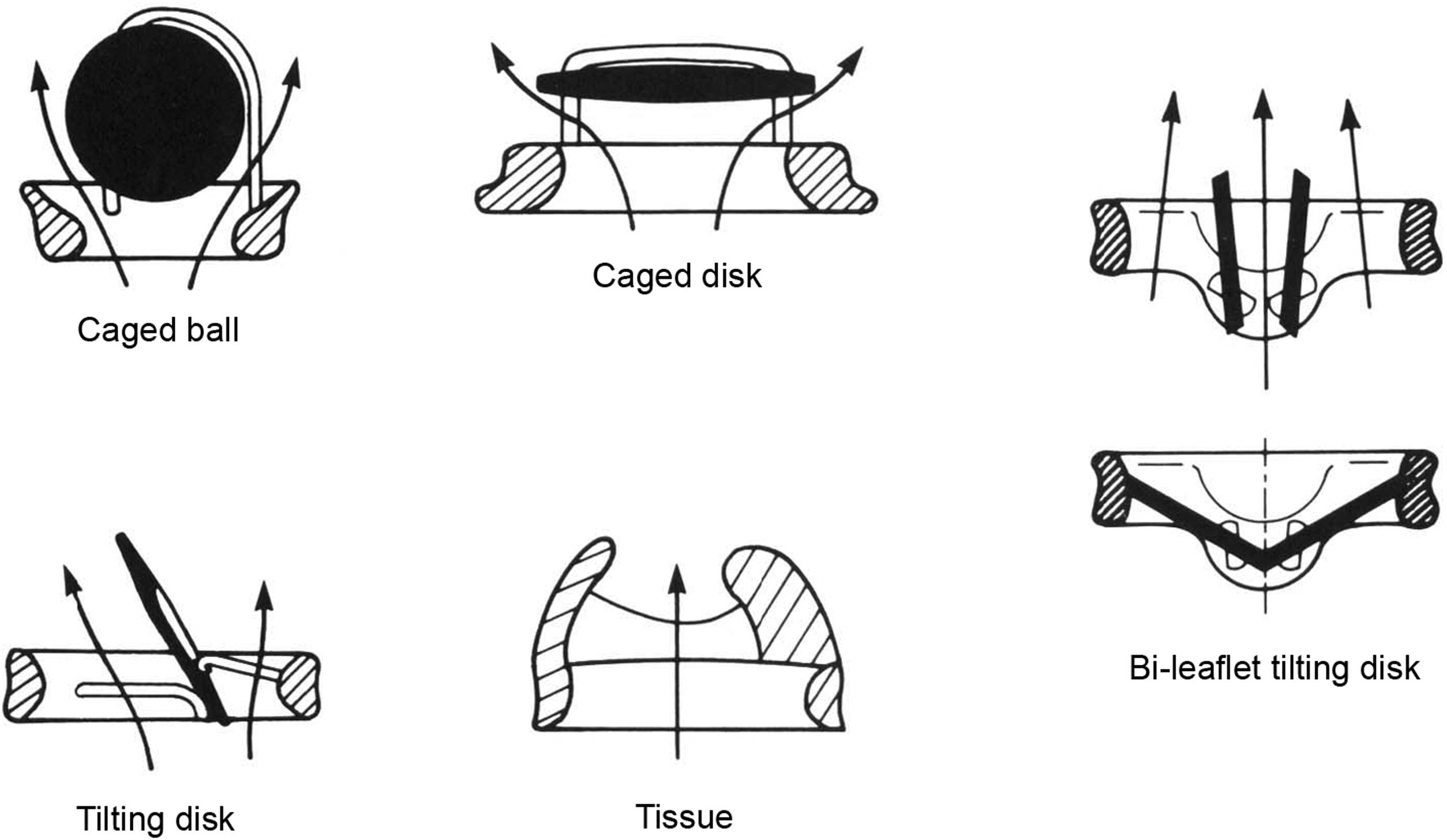 Figure 17.3, Designs and flow patterns of major categories of prosthetic heart valves: caged-ball, caged-disk, tilting-disk, bileaflet tilting-disk, and bioprosthetic (tissue) valves. Whereas flow in mechanical valves must course along both sides of the occluder, bioprostheses have a central flow pattern.