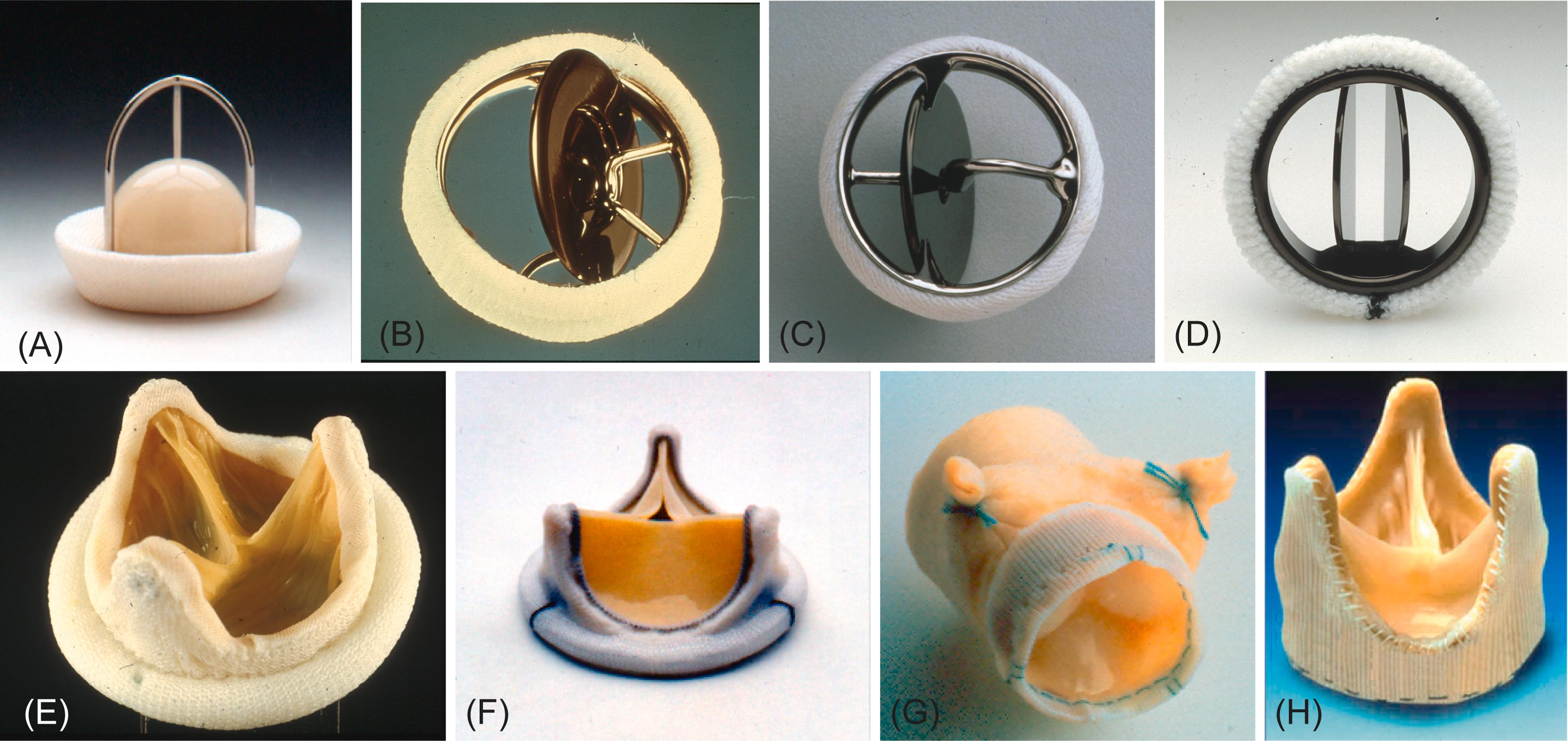 Figure 17.4, Mechanical and bioprosthetic heart valve configurations. (A) Starr-Edwards caged-ball valve. (B) Bjork-Shiley tilting-disk valve. (C) Medtronic-Hall monostrut tilting-disk valve. (D) St Jude Medical bileaflet tilting-disk heart valve. (E) Hancock porcine aortic valve bioprosthesis. (F) Carpentier-Edwards bovine pericardial valve. (G) Stentless Medtronic Freestyle valve. (H) Stentless St Jude Medical Toronto SPV valve.