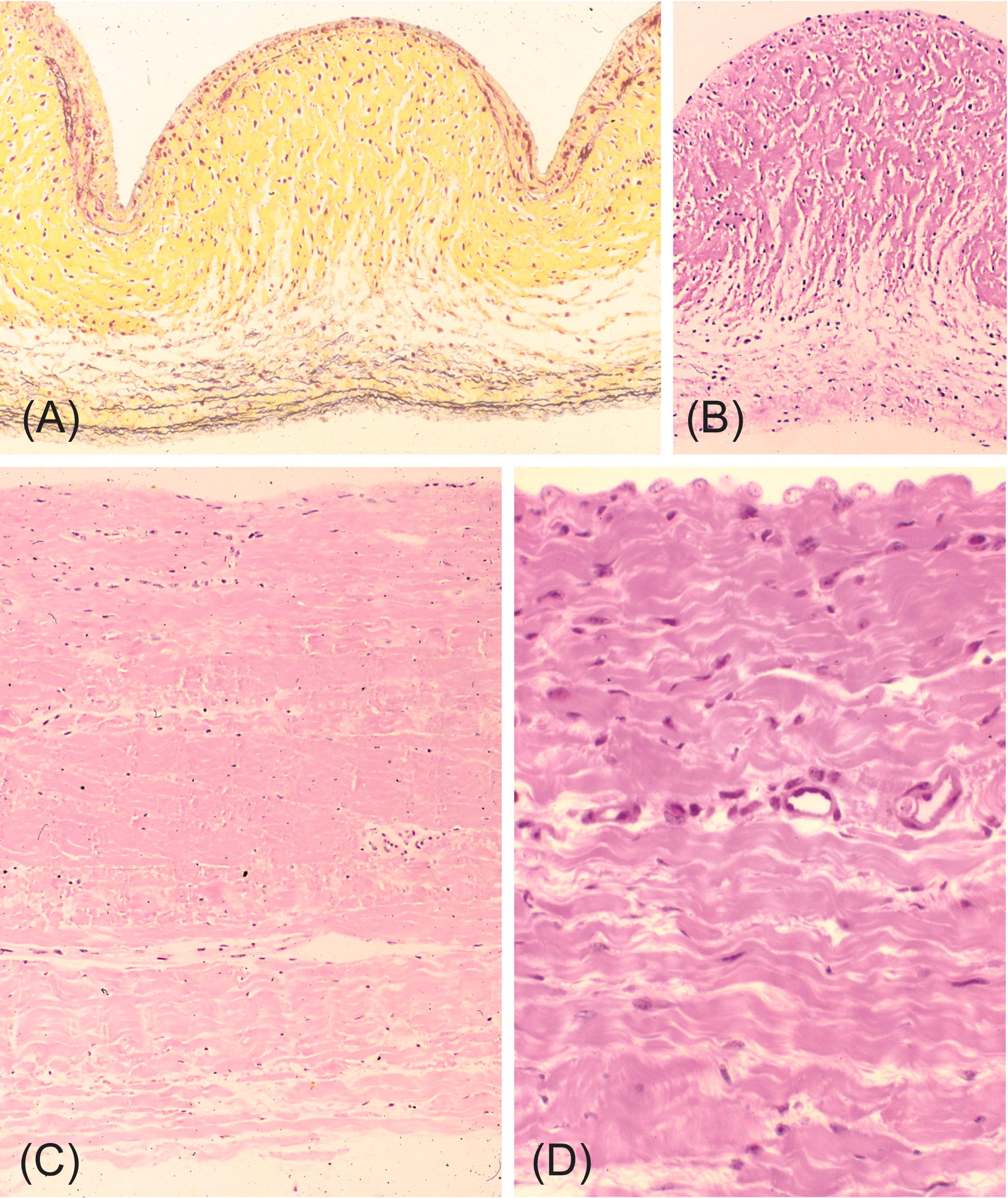 Figure 17.5, Comparison of microscopic structures of porcine aortic valve and bovine pericardium. (A) Cross section of porcine aortic valve cusp in the nondistended state (corresponding to systole), showing layered architecture with diffusely distributed interstitial cells. Outflow surface at top. Movat pentachrome stain (collagen is yellow ; elastin is black ). (B) Cross section of porcine aortic valve cusp outflow surface at top. (C) Cross section of bovine parietal pericardium, showing dense laminated fibrous tissue with diffusely distributed cells. (D) Higher power photomicrograph of bovine pericardium showing collagen bundles and fibroblasts. In (C) and (D), the serosal surface is at top. (B–D) Hematoxylin and eosin.